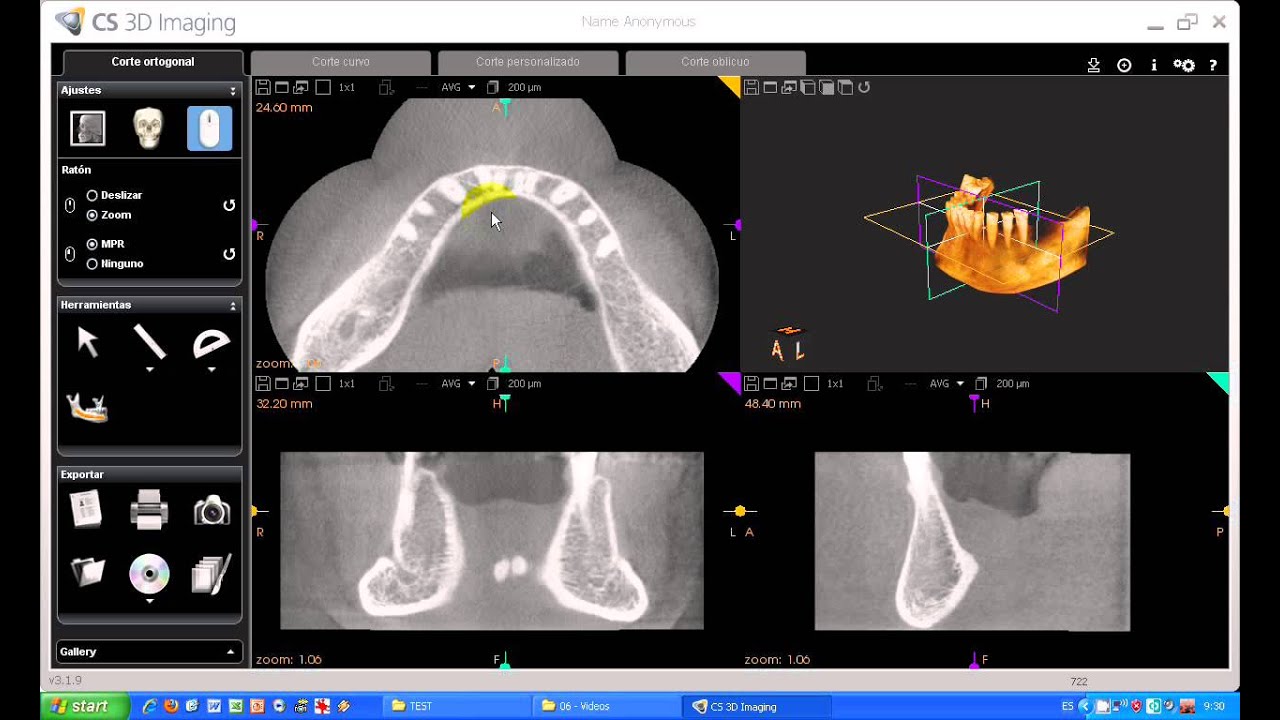 Cs 3d imaging nerve canal tool